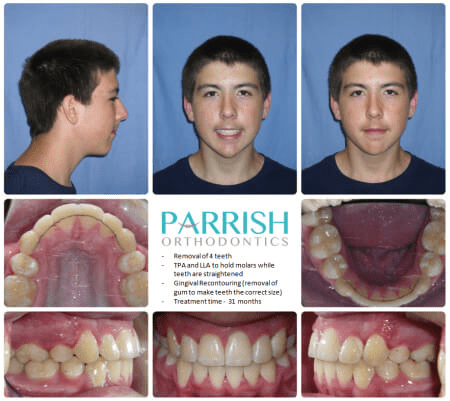 Removal Of 4 Teeth After