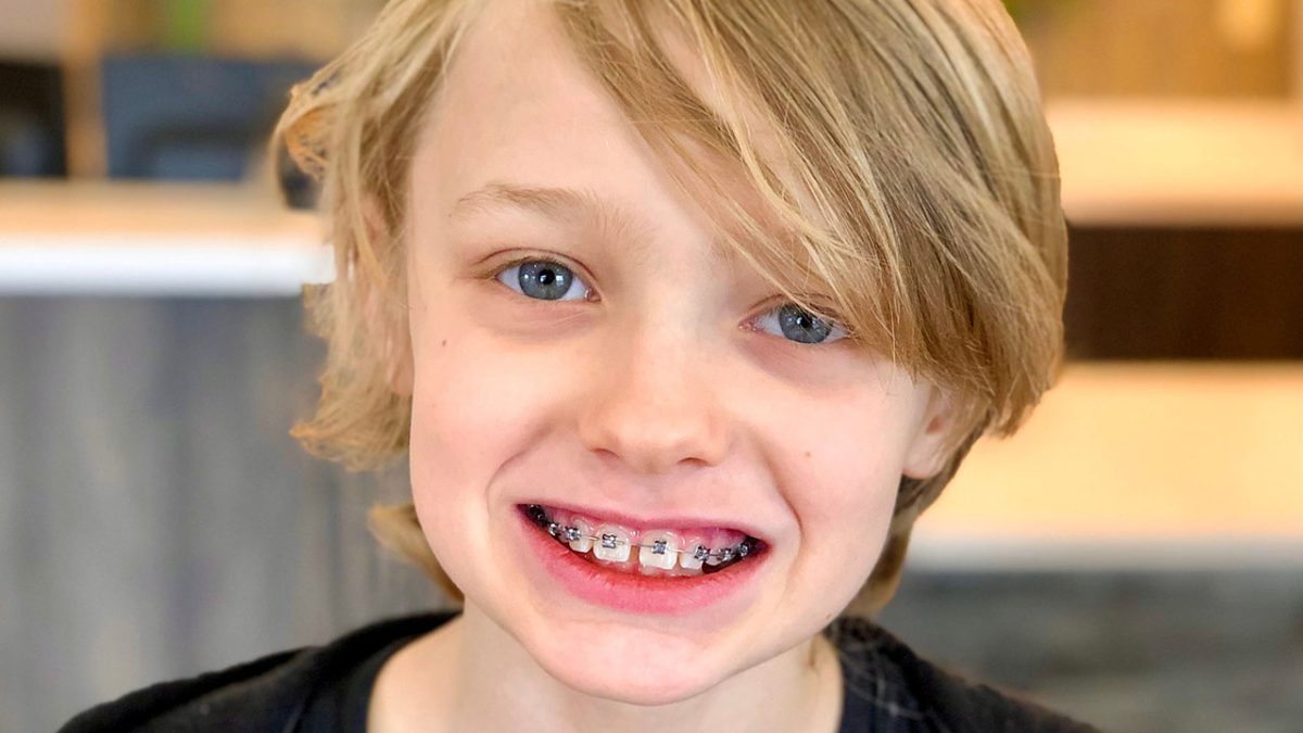 Fort Wayne IN Phase 1 Treatment Orthodontists