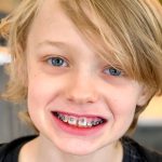 Fort Wayne IN Phase 1 Treatment Orthodontists