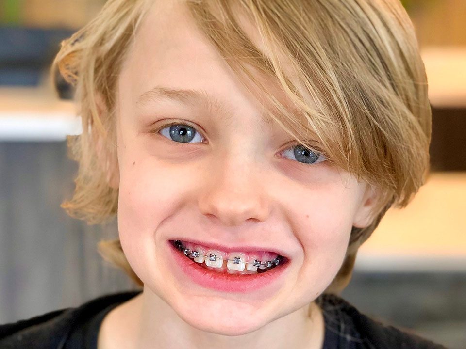 Fort Wayne IN Phase 1 Treatment Orthodontists