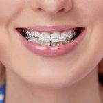 Fort Wayne IN Ceramic Braces Orthodontists