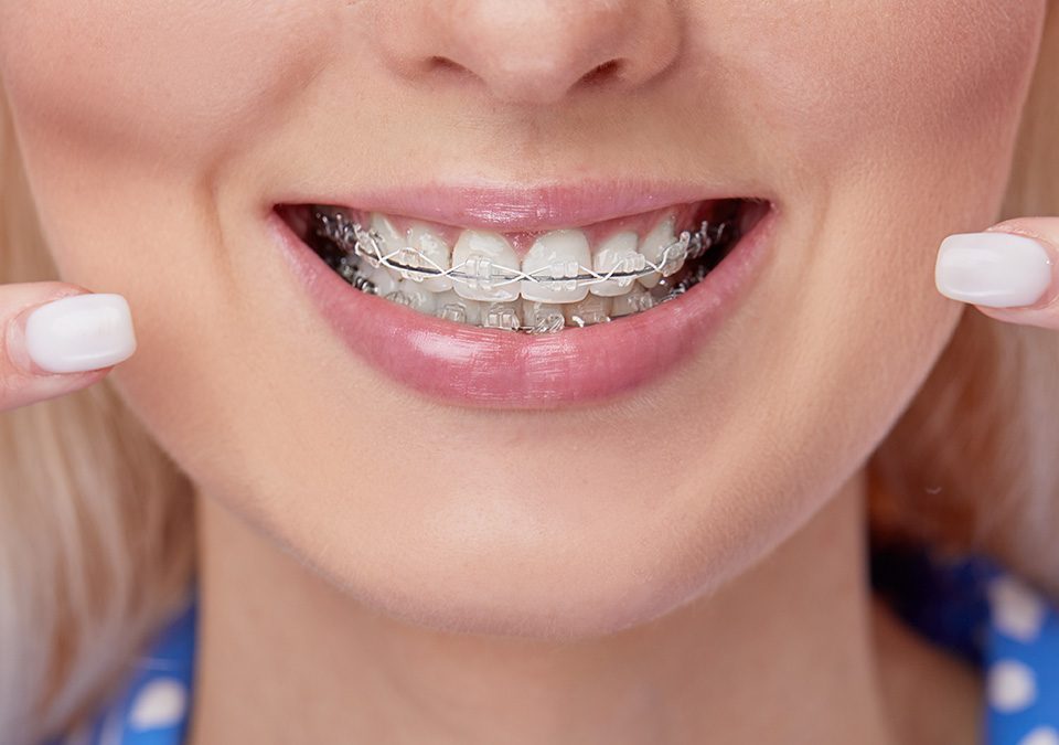 Fort Wayne IN Ceramic Braces Orthodontists