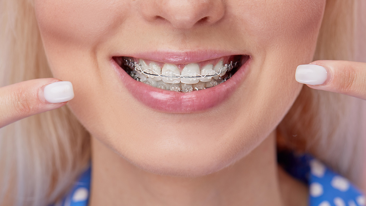 Fort Wayne IN Ceramic Braces Orthodontists